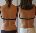 Weight Loss in Des Moines