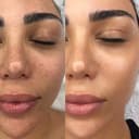 Hinsdale Vein and Laser